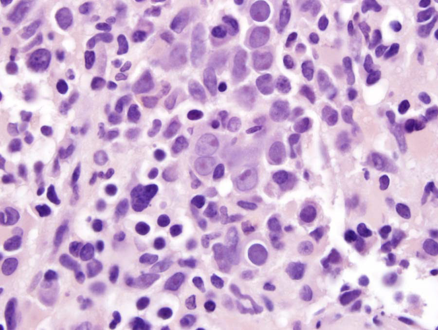 Fig 1B BMX 100x immature mononuclear cells